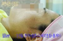 치료 후
