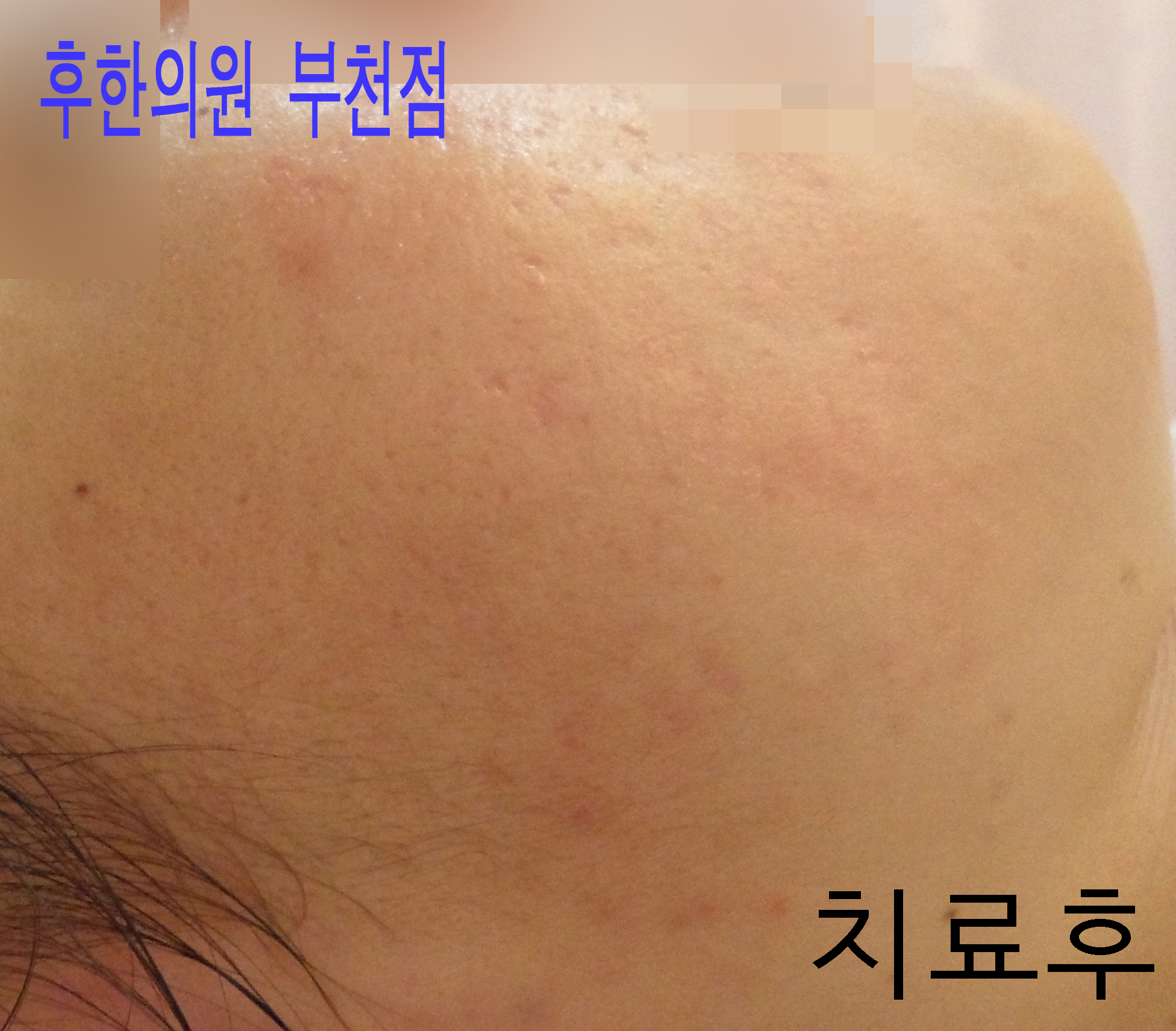 치료 후