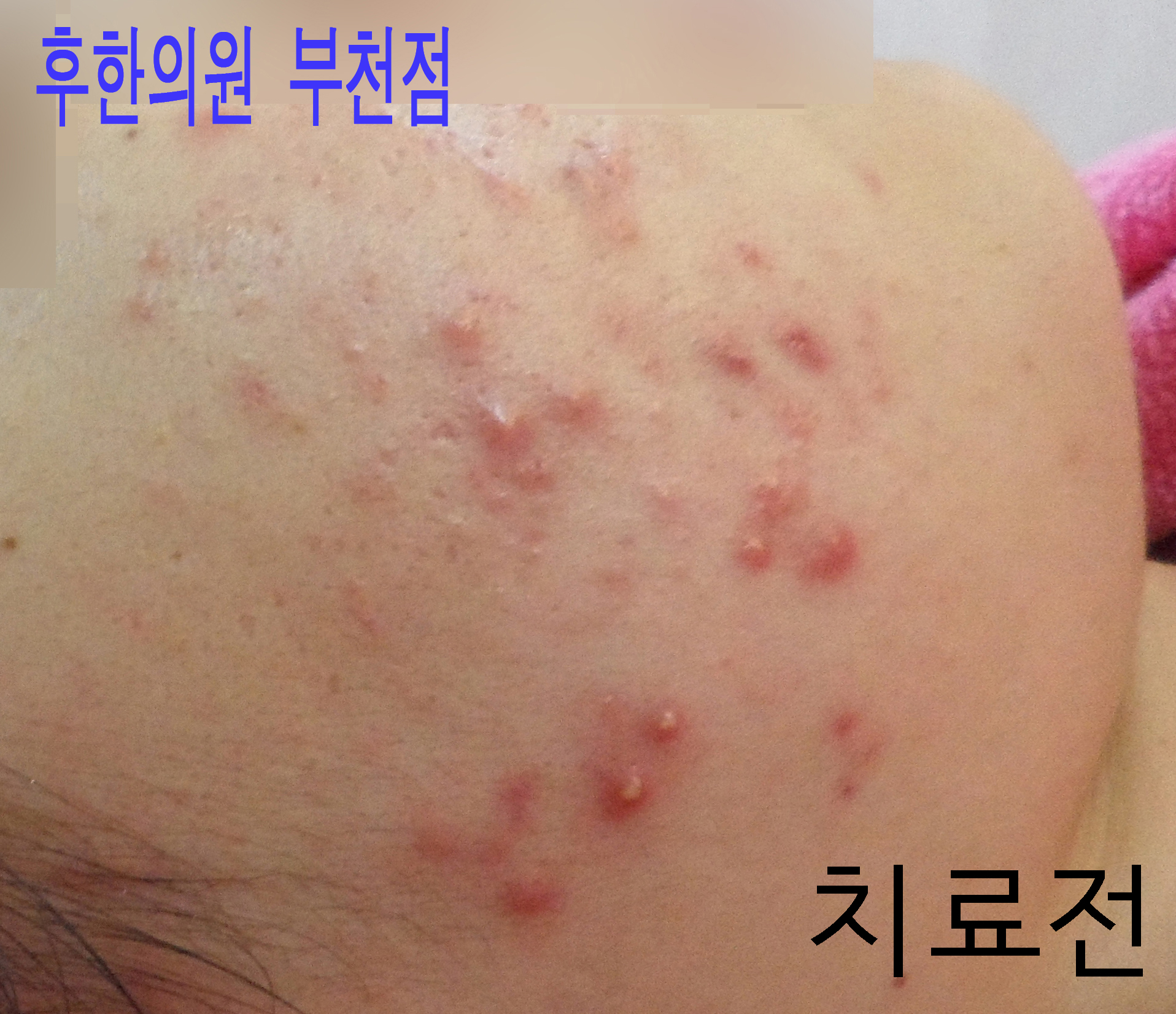 치료 전