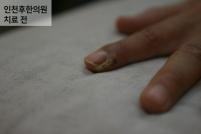 치료 전