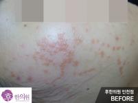 치료 전