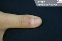 치료 후