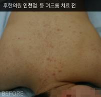 치료 전