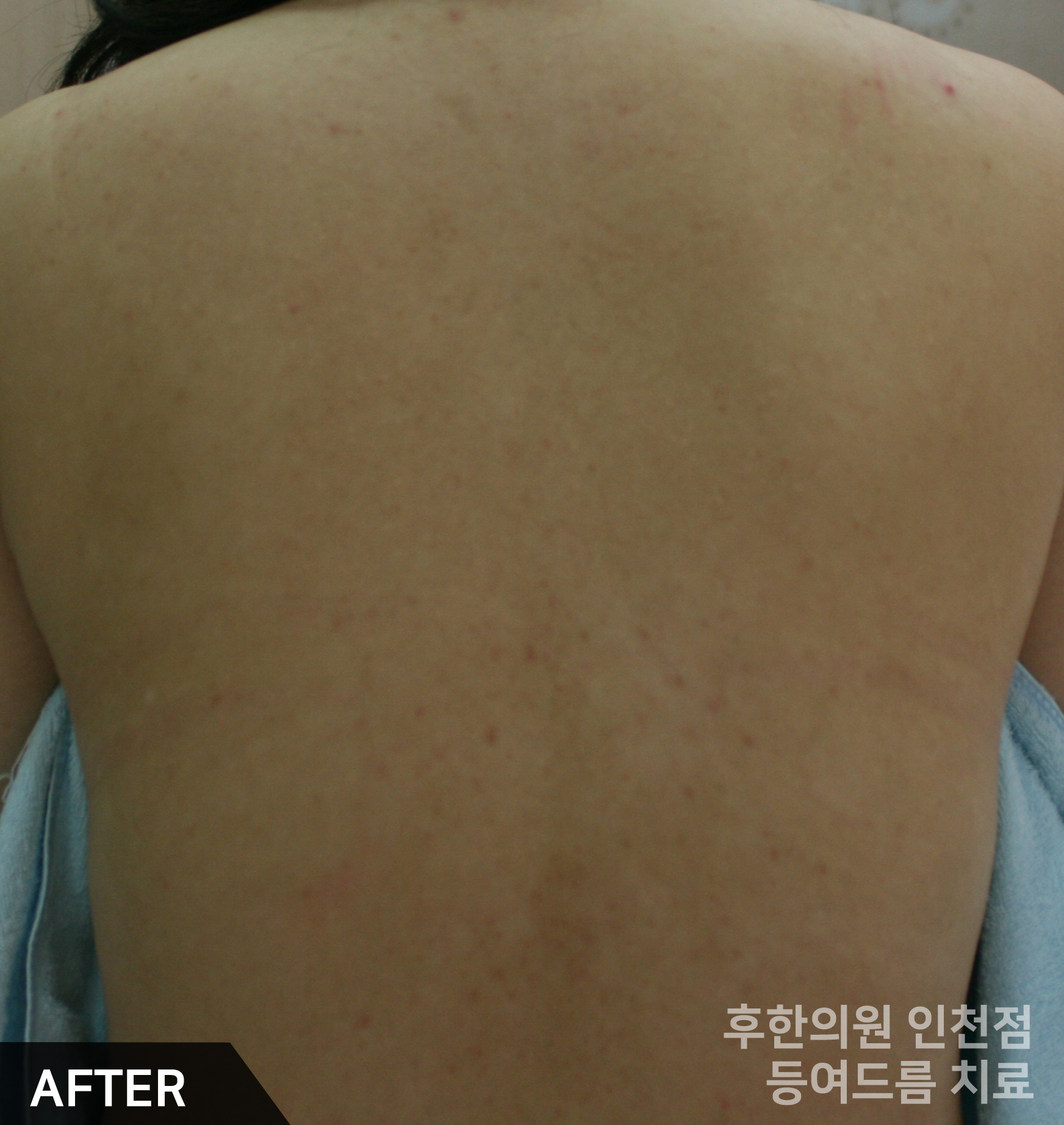 치료 후