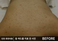 치료 전