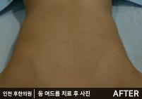 치료 후