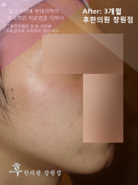 치료 후