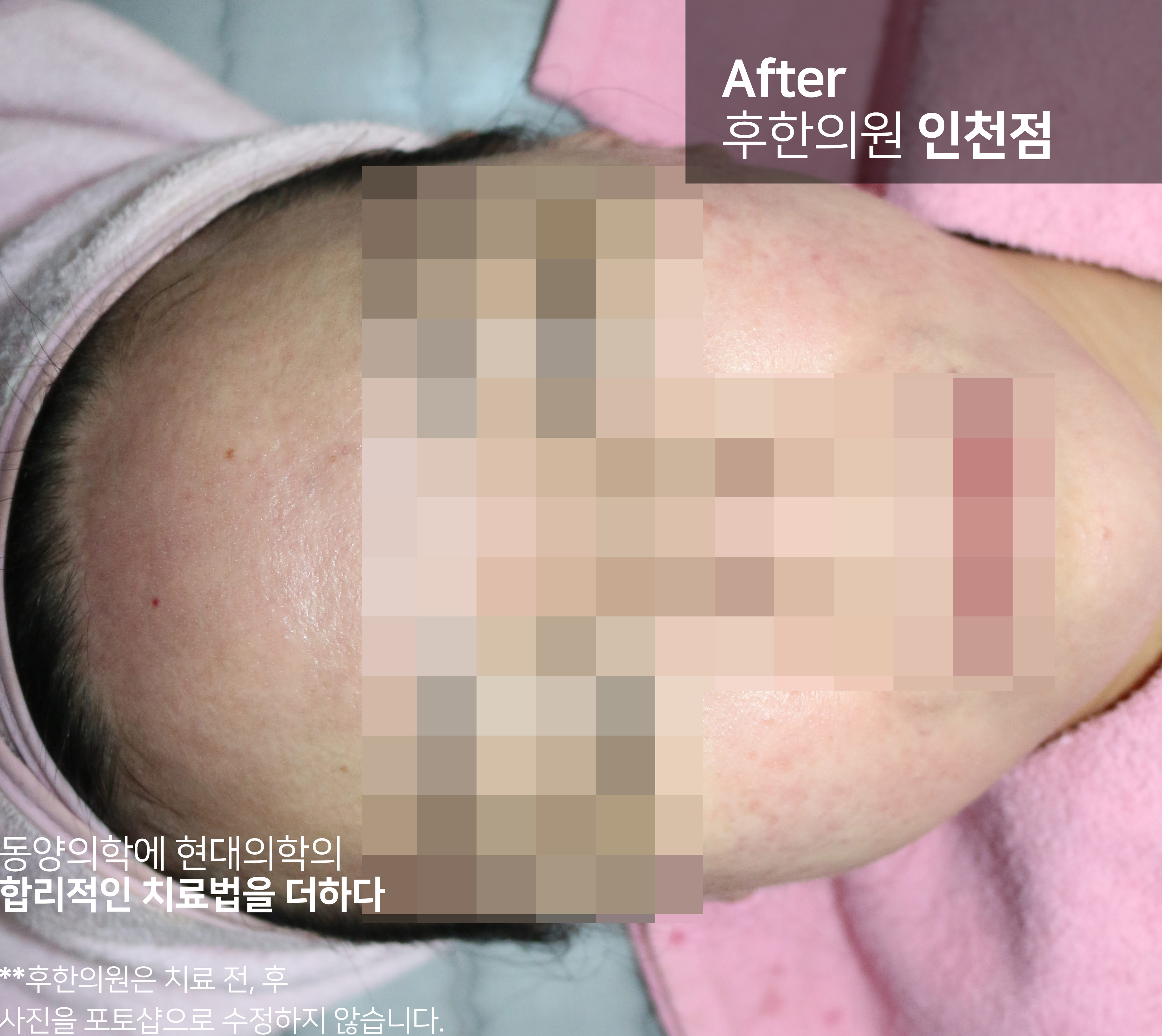 치료 후