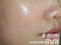 치료 후