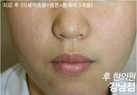 치료 후