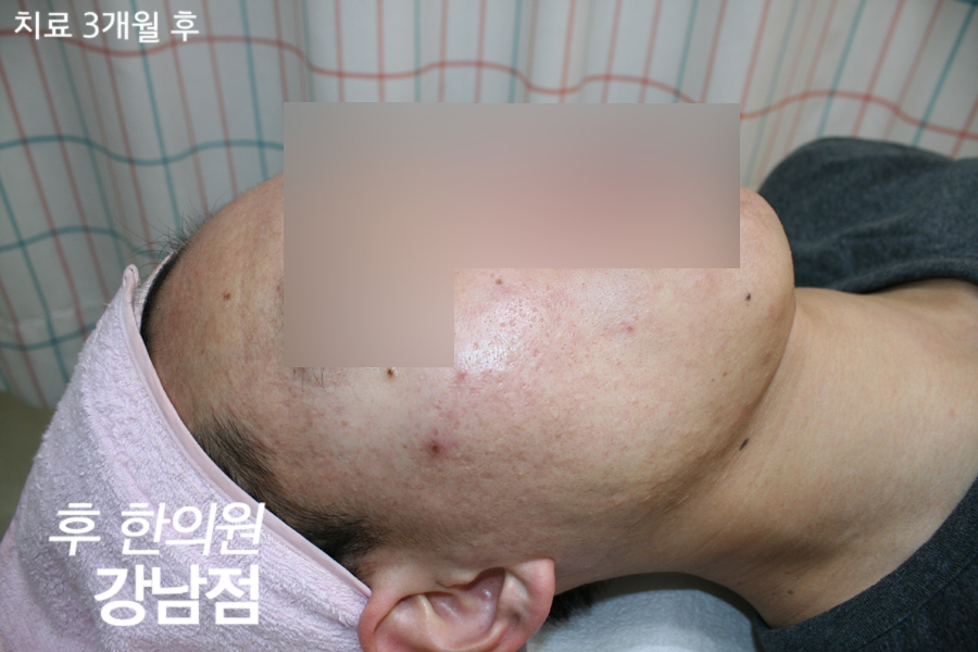 치료 후