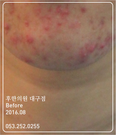 치료 전