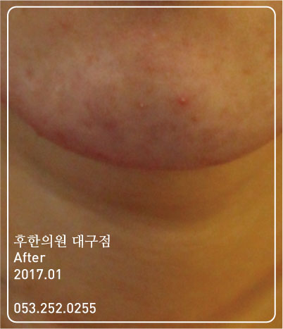 치료 후