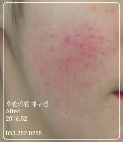 치료 후