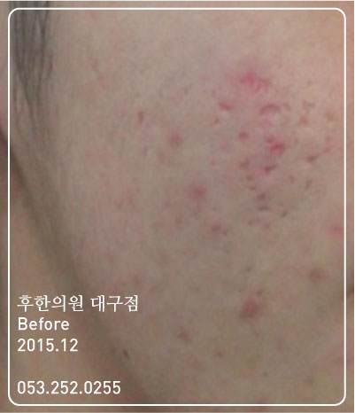 치료 전