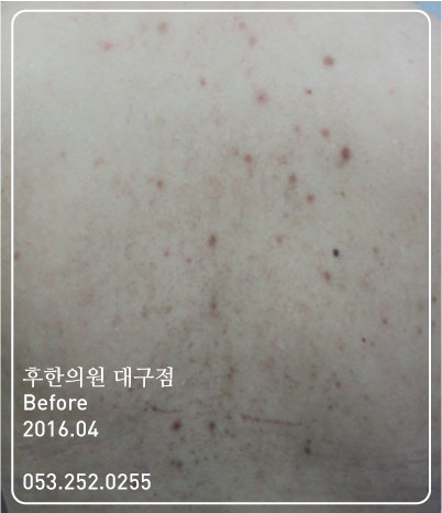 치료 전