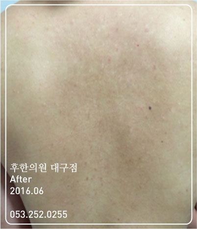 치료 후