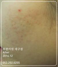 치료 후