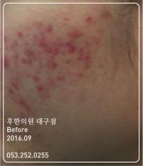 치료 전