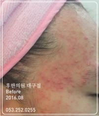 치료 전