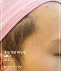 치료 후