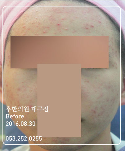 치료 전