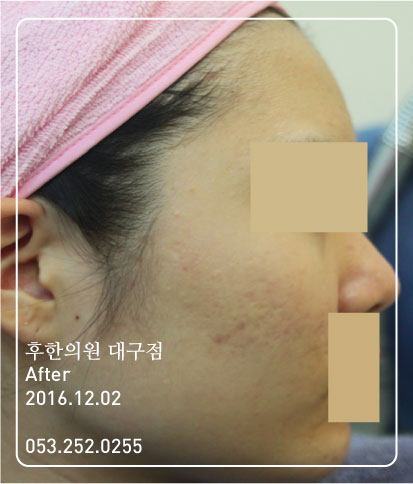 치료 후