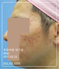 치료 후