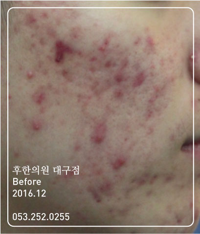 치료 전