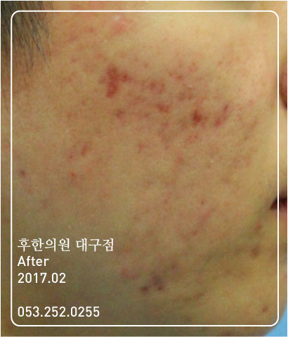 치료 후