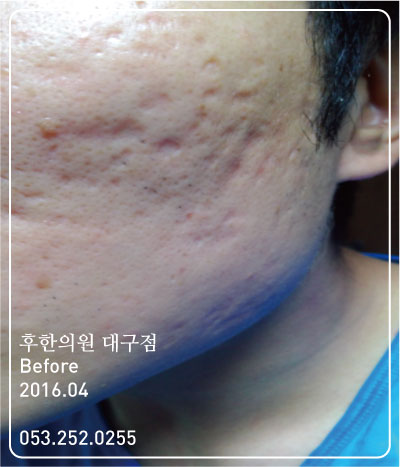치료 전