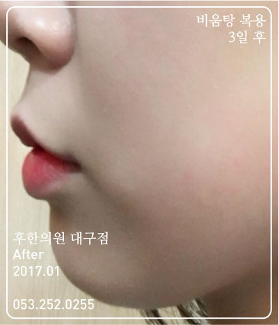치료 후