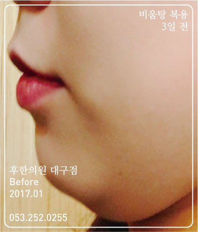 치료 전