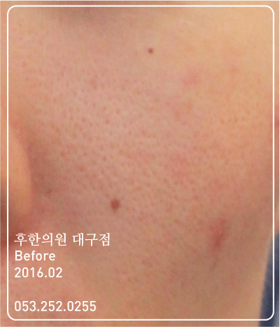 치료 전