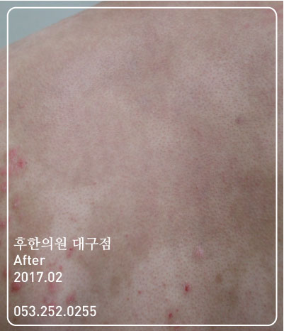 치료 후