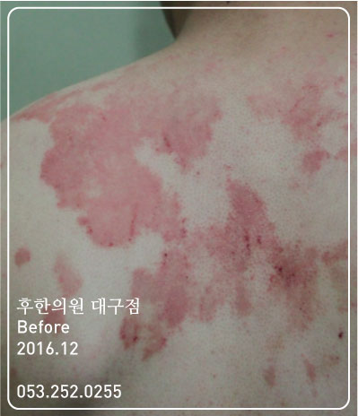 치료 전