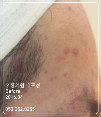 치료 전
