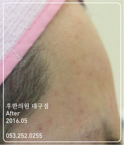 치료 후