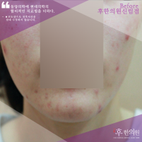 치료 전