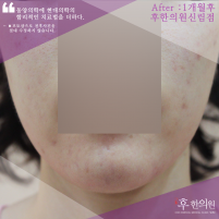 치료 후