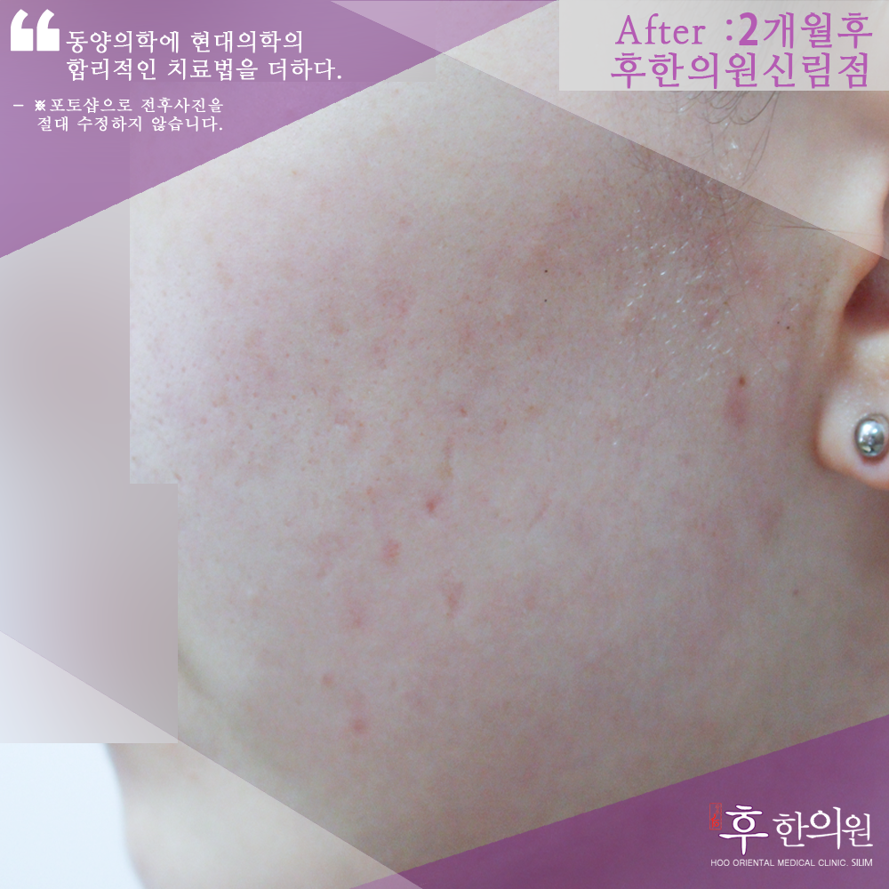 치료 후