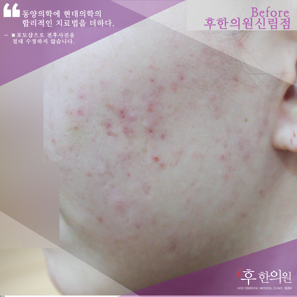 치료 전
