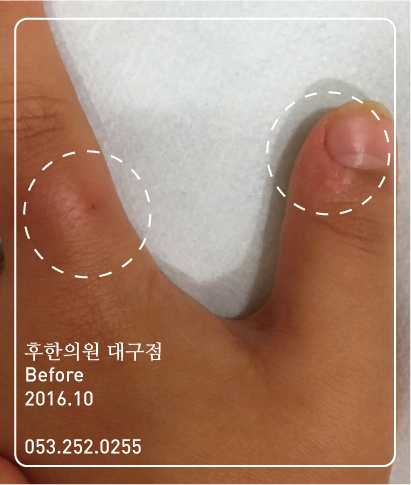 치료 전