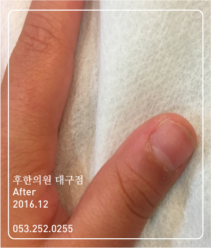 치료 후