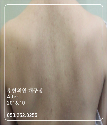 치료 후