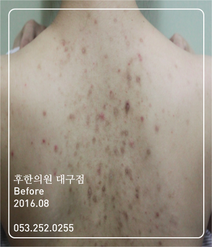 치료 전