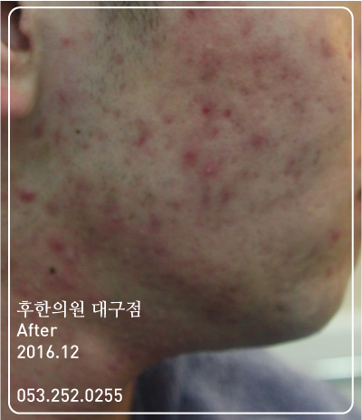 치료 후