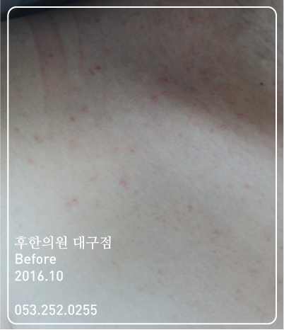 치료 전