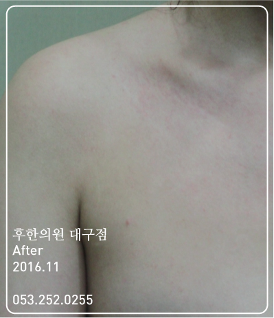 치료 후