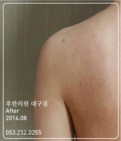 치료 후